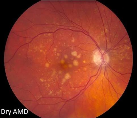 AMD: The Current Anti-VEGF Landscape