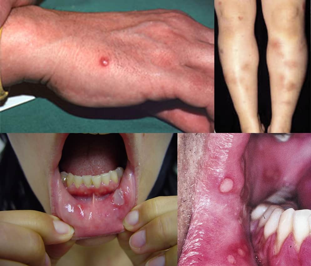 Behcet Disease: The Treatment Revolution