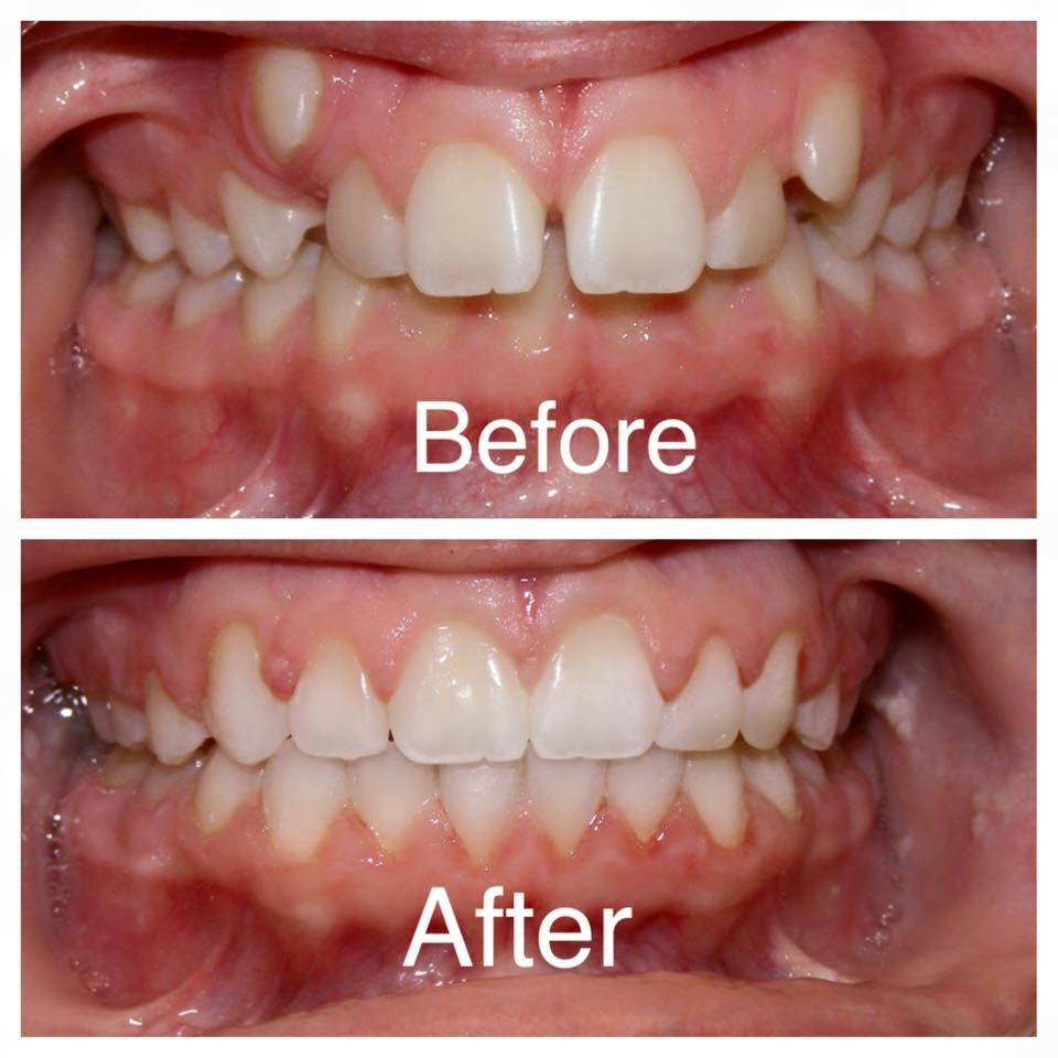 Braces & Orthodontic Treatment