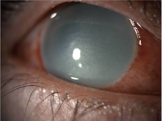 Chemical Eye Injury: Roper-Hall vs Dua Grading