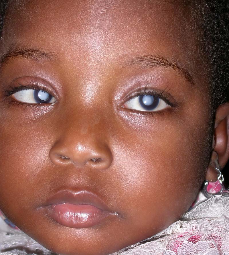 Congenital Cataract: Timing & Management