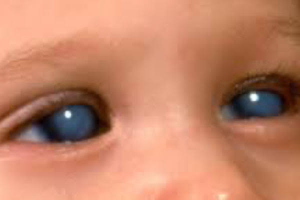 Primary Congenital Glaucoma