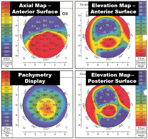 Corneal Topography