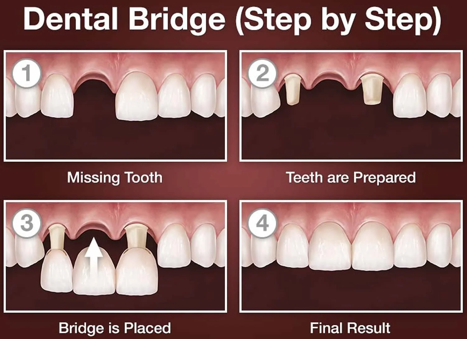 Dental Crowns & Bridges