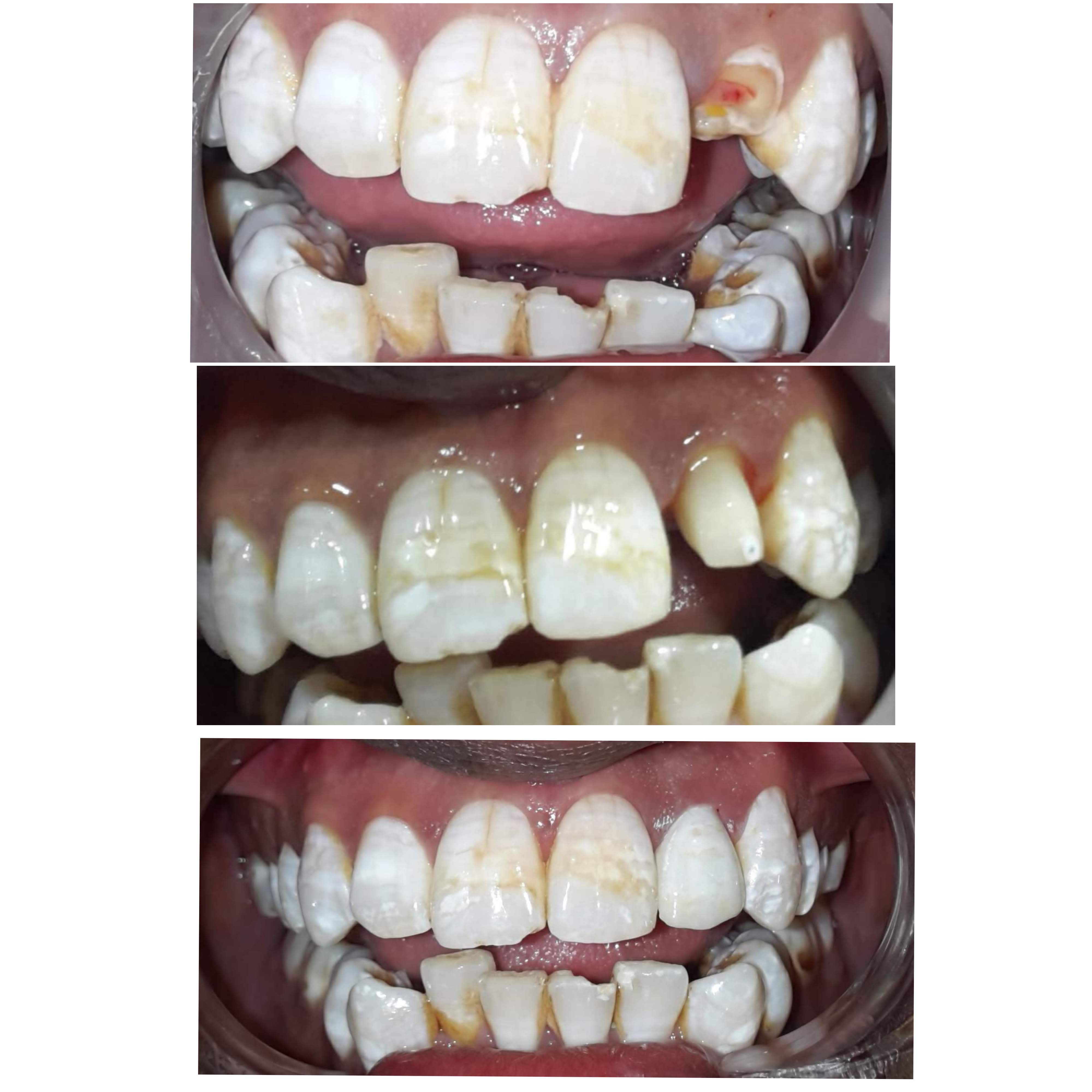 Dental case: Tooth Reconstruction