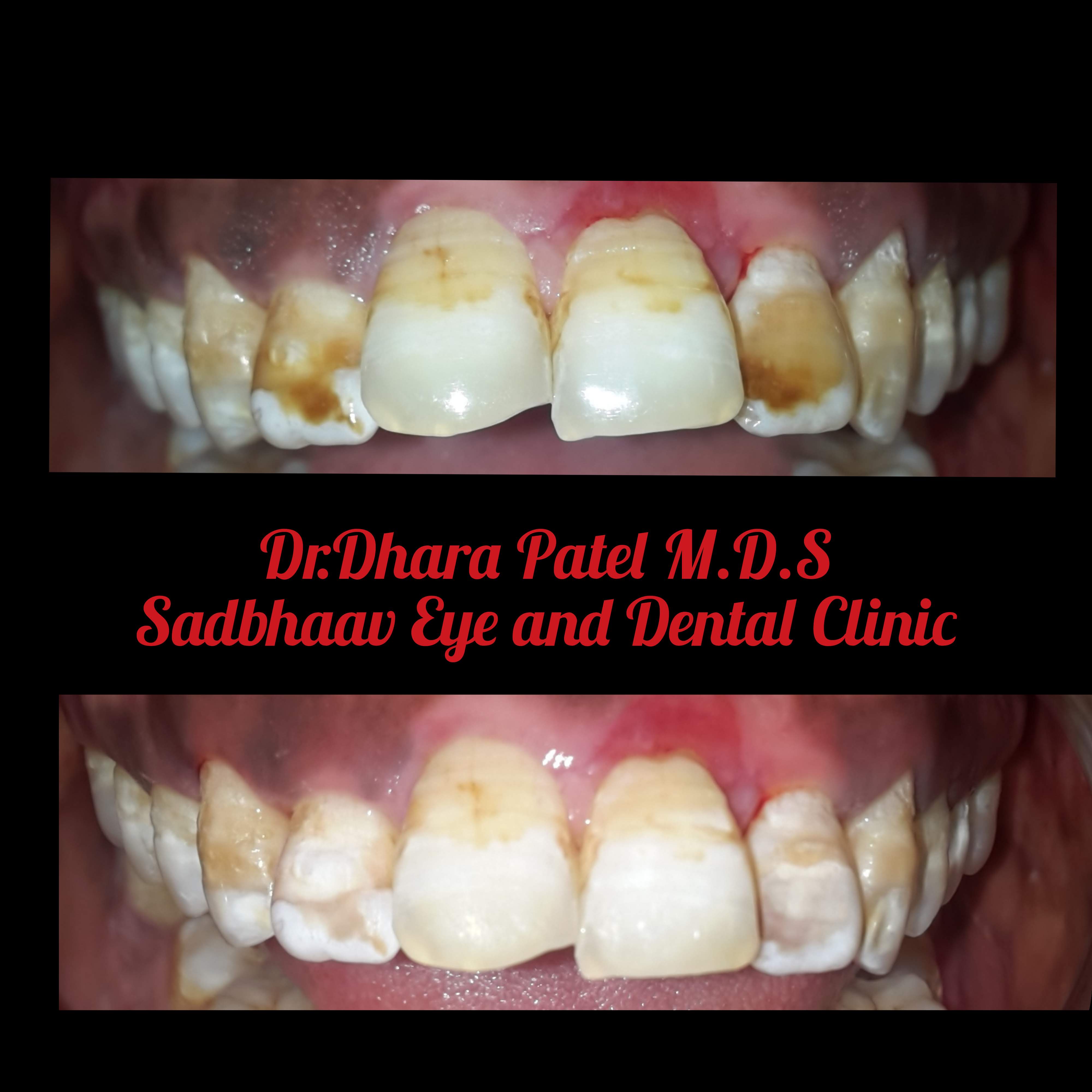 Dental case: Dental Bleaching