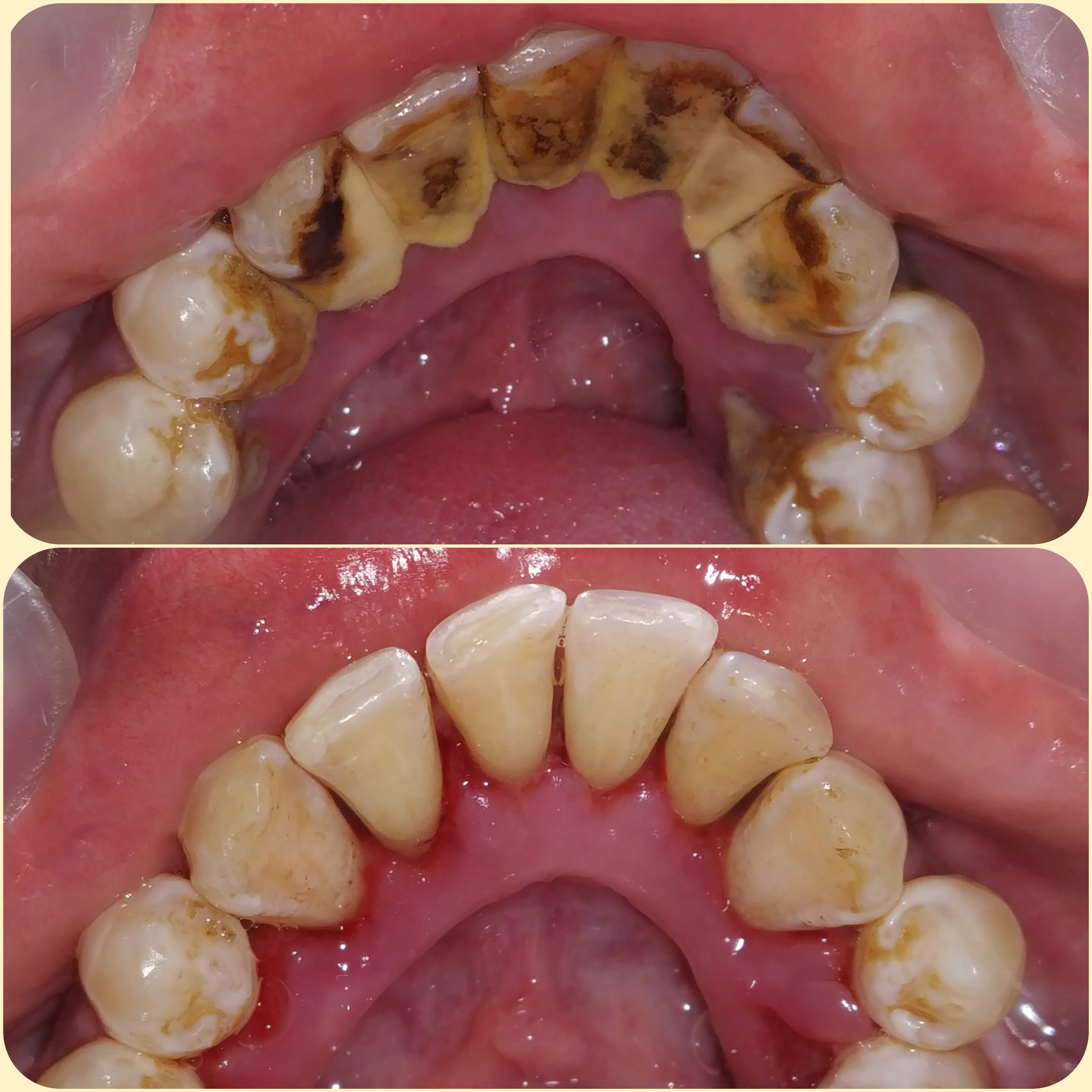 Dental case: Scaling