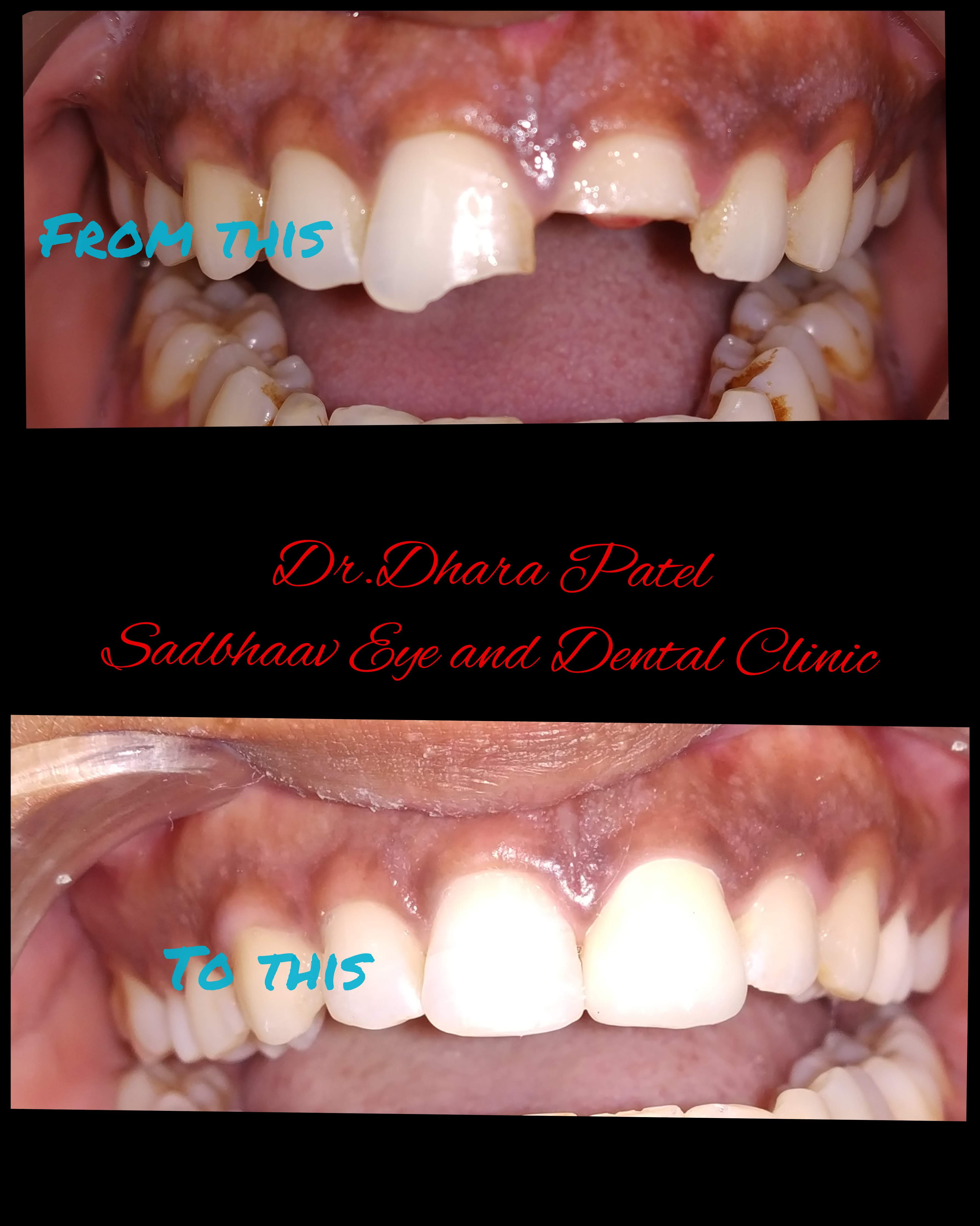 Dental case: Broken Tooth Management