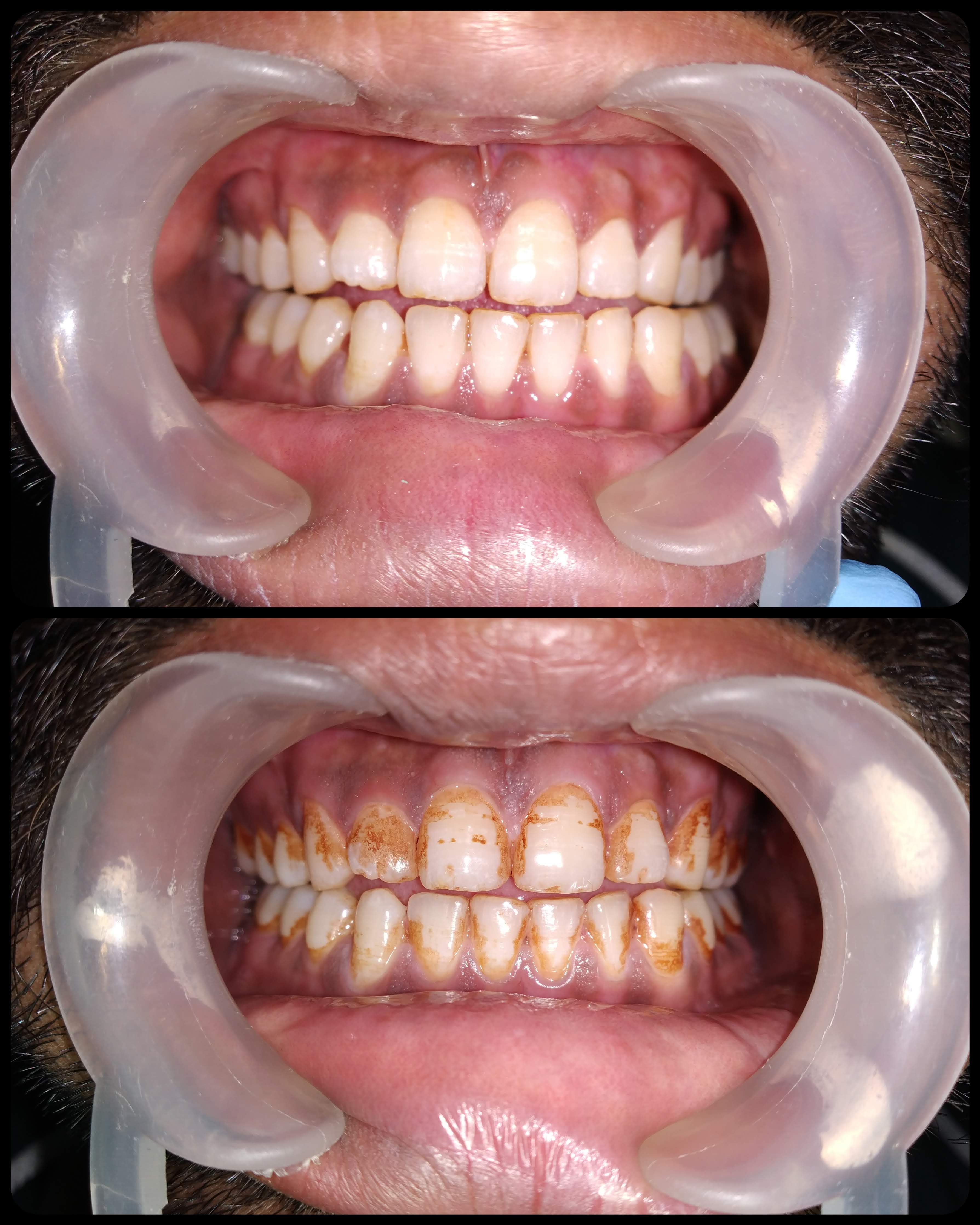 Dental case: Tobacco Stain Removal