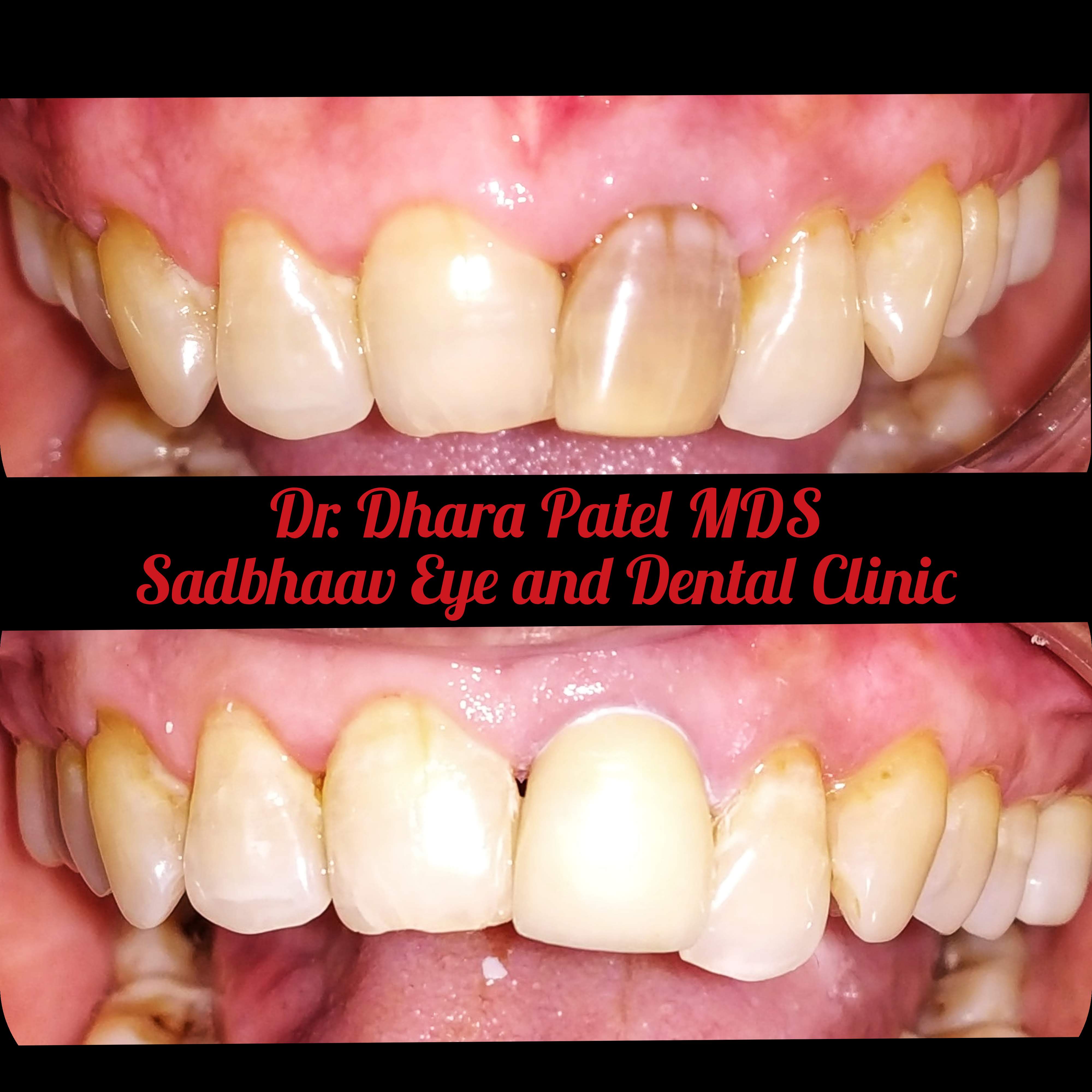 Dental case: Discoloured Tooth Management