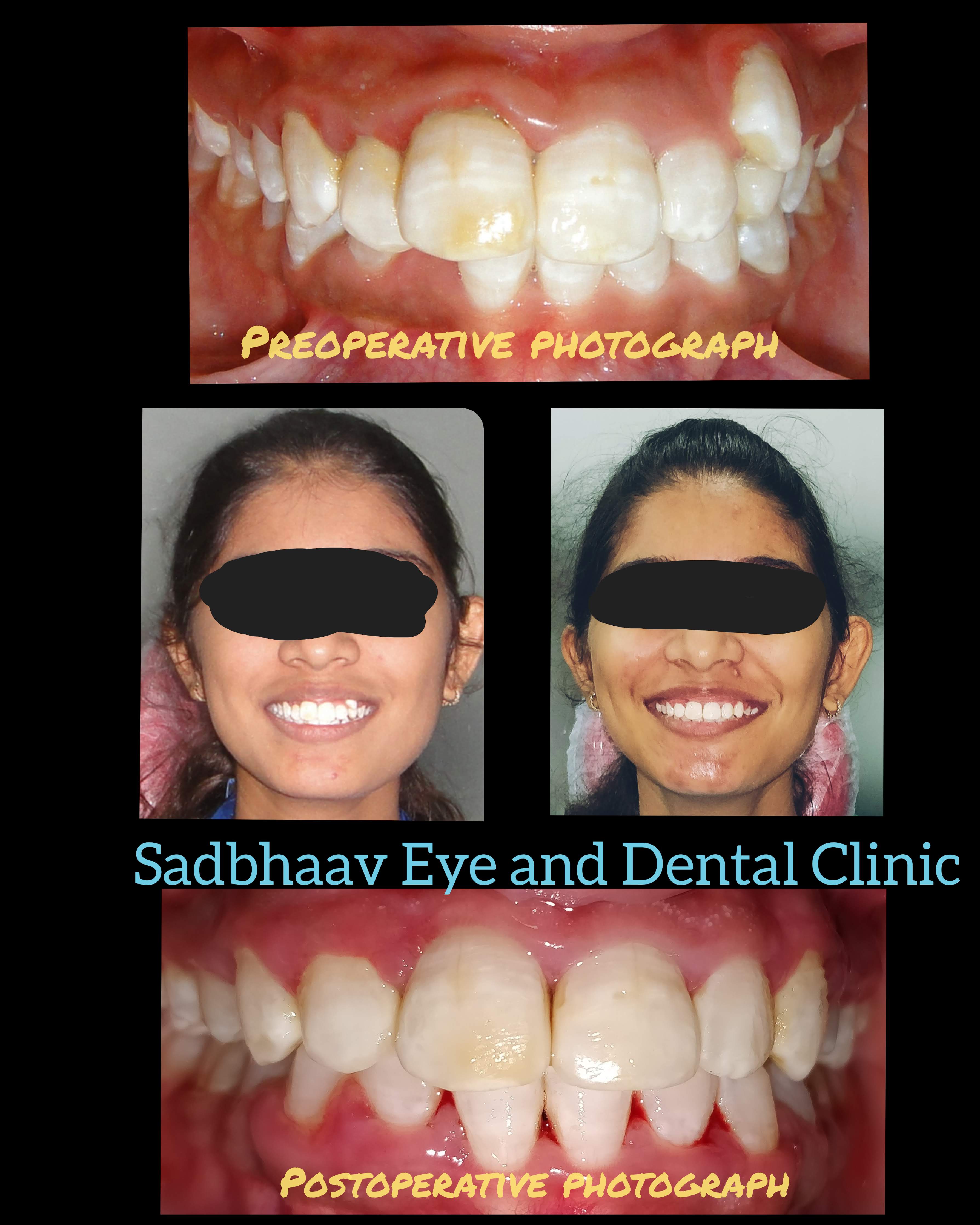 Dental case: Orthodontic Treatment for Malpositioned Teeth