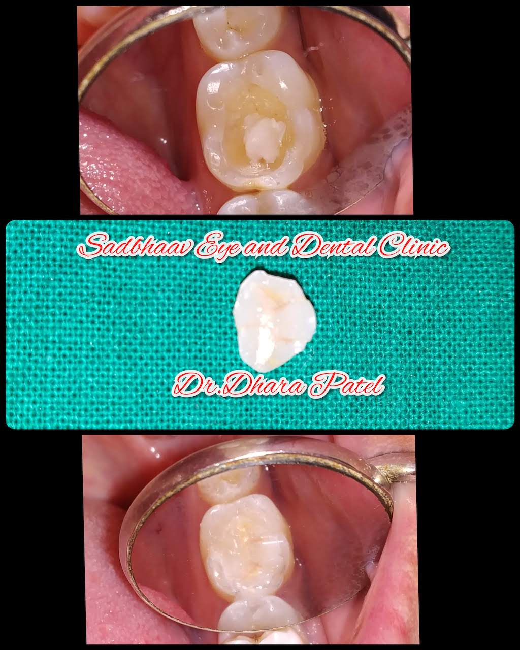 Dental case: Dental Inlays