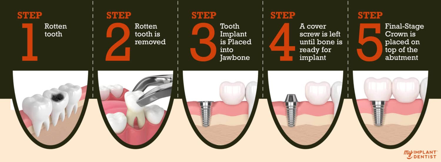 Dental Implants