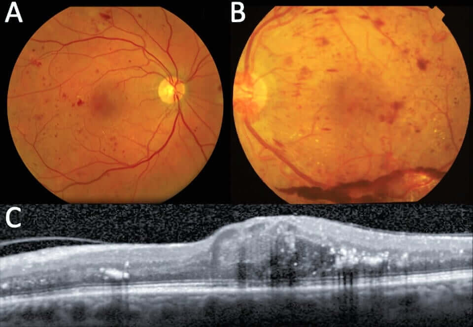 Diabetic Retinopathy Treatment