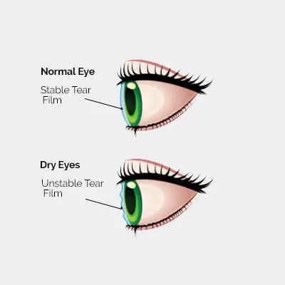 Dry Eye Treatment