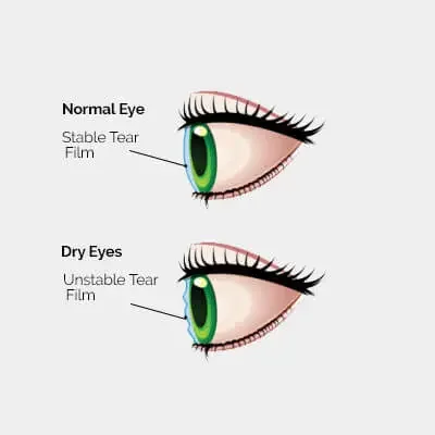 Dry Eye Treatment