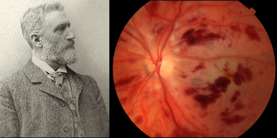 Eponymous Signs in Ophthalmology