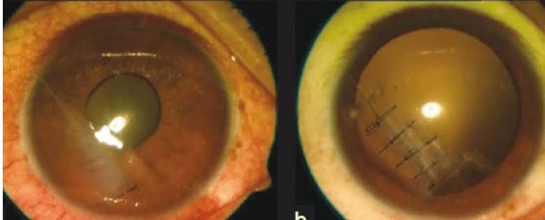 Eye Injury & Emergency Treatment