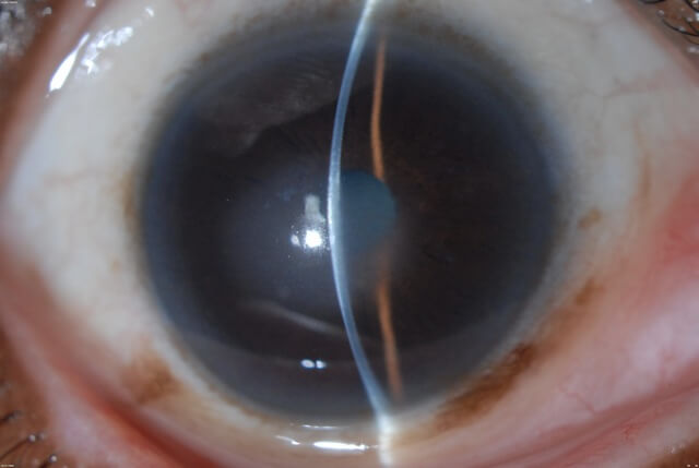 Fuchs Endothelial Corneal Dystrophy