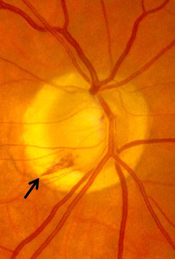 Glaucoma