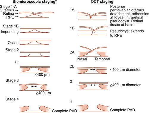 Optic Disc Staging Systems Effective in Grading Advanced Glaucoma