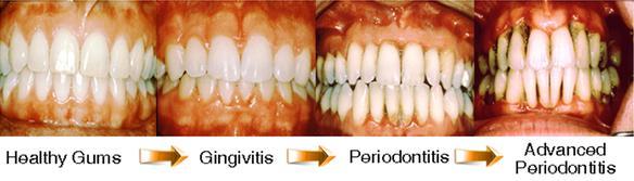 Gum Disease Treatment