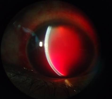 Traumatic Hyphema: Current Management