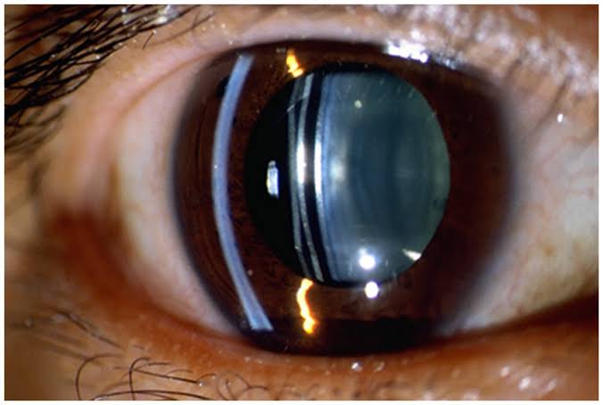 Phakic Intraocular Lens (ICL)
