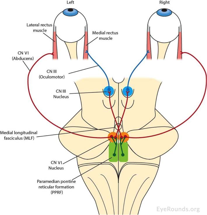 Internuclear Ophthalmoplegia (INO)