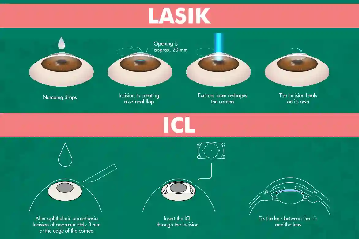 LASIK vs ICL comparison