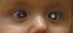 Leukocoria: A Differential