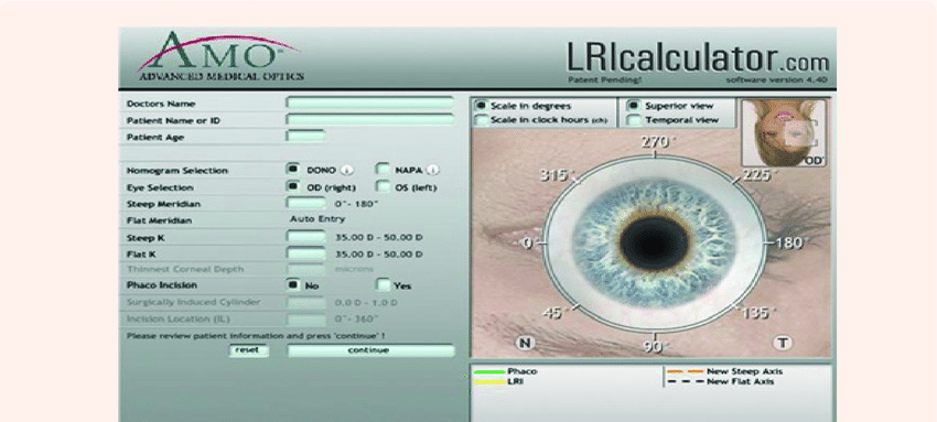 LRI Calculator: Nomograms for Limbal Relaxing Incisions