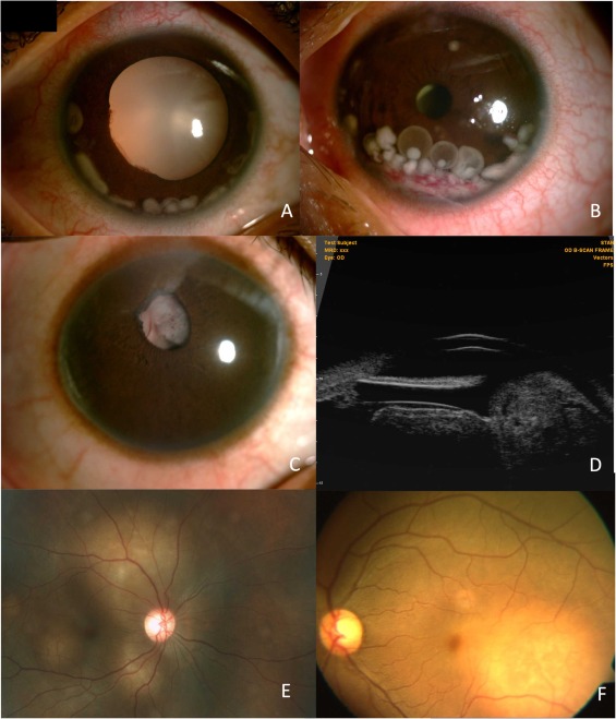 Uveitis Masquerade Syndromes