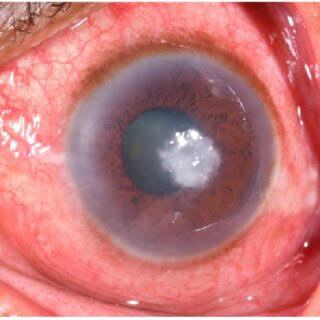 Microbial Keratitis: A Workup Approach