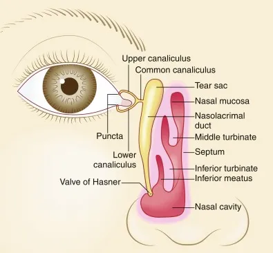 Congenital NLD Obstruction: When to Wait, When to Act