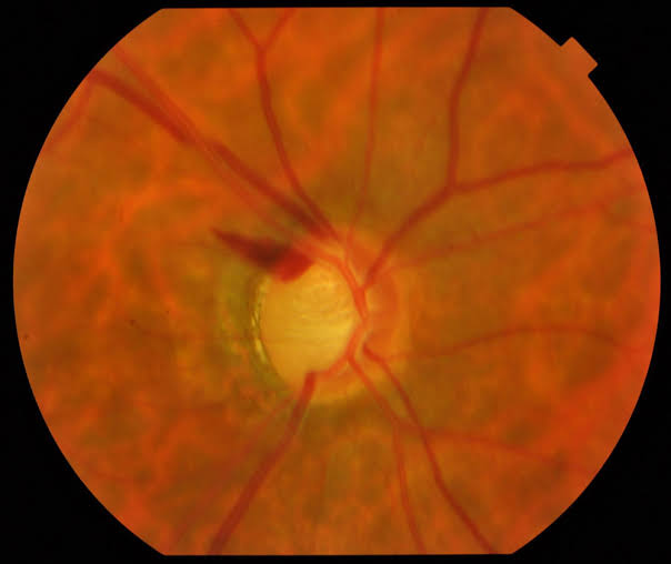 Normal-Tension Glaucoma: Diagnosis and the CNTGS Debate