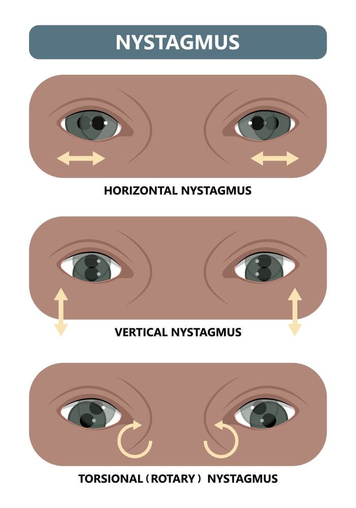 Nystagmus: A Classification Approach