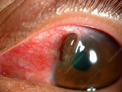 Open Globe Injury: The BETT Classification