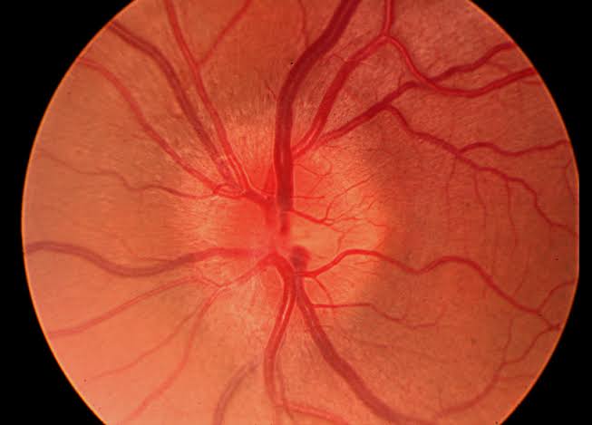 Optic Neuritis: Typical vs Atypical