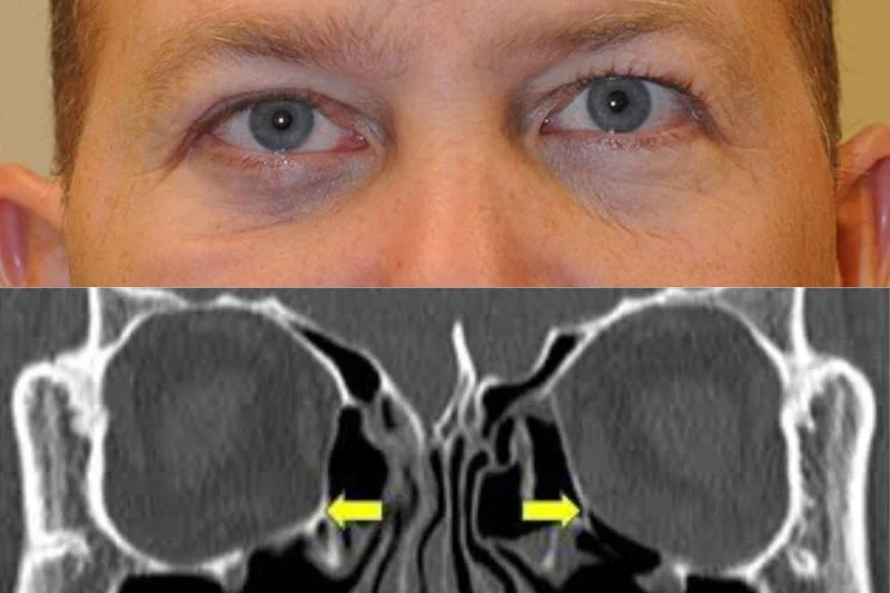 Orbital Fracture: Emergency vs Observation