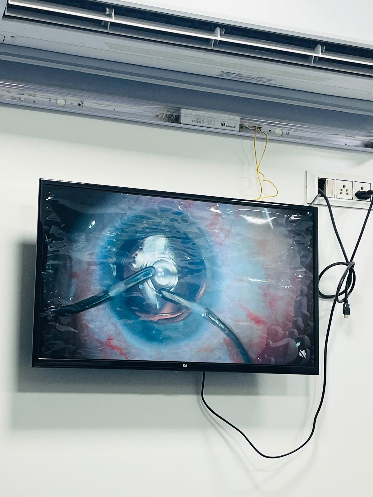 Cataract surgery in progress at Sadbhaav Eye Clinic operation theatre