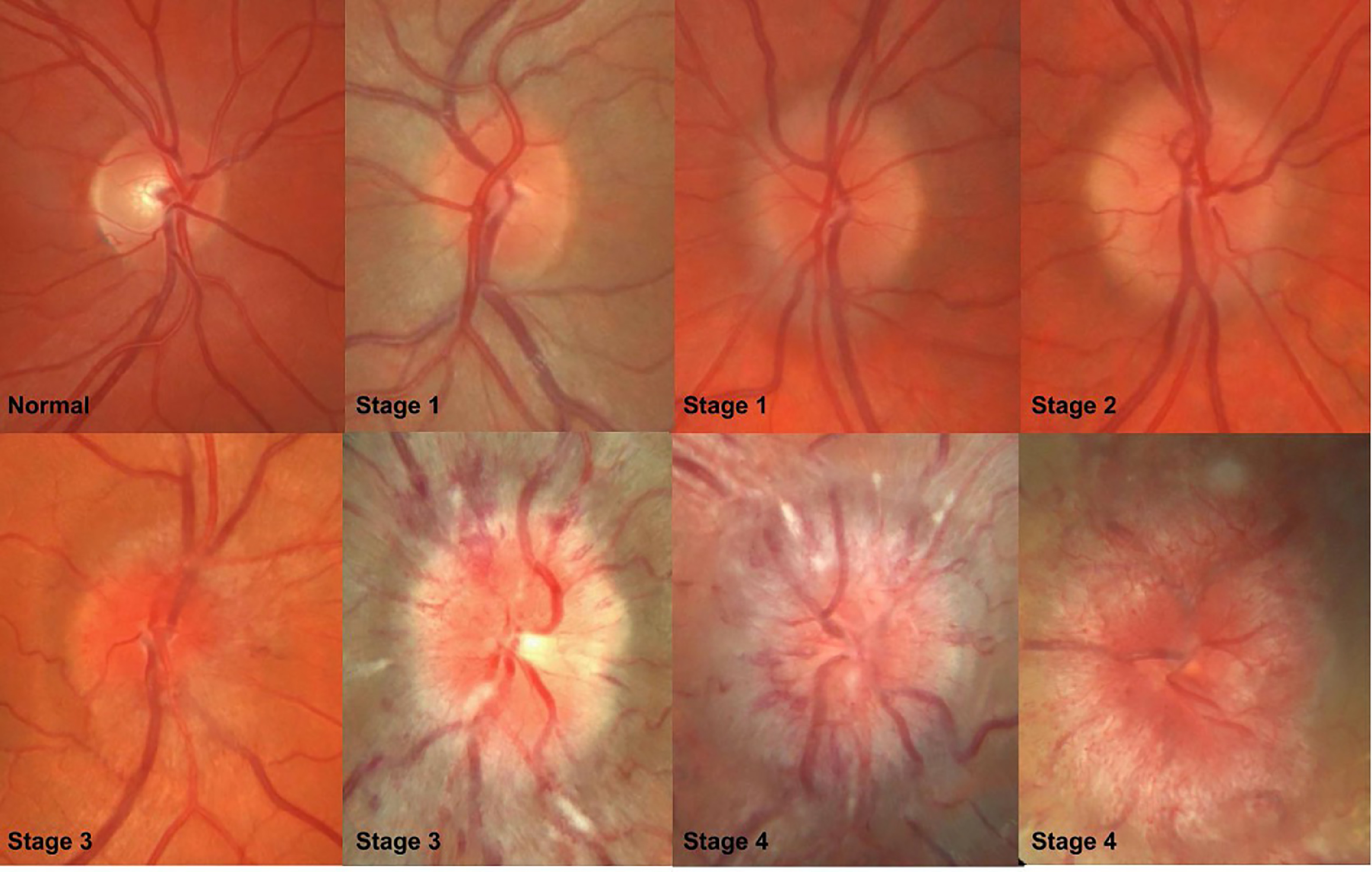 Papilledema vs Pseudopapilledema