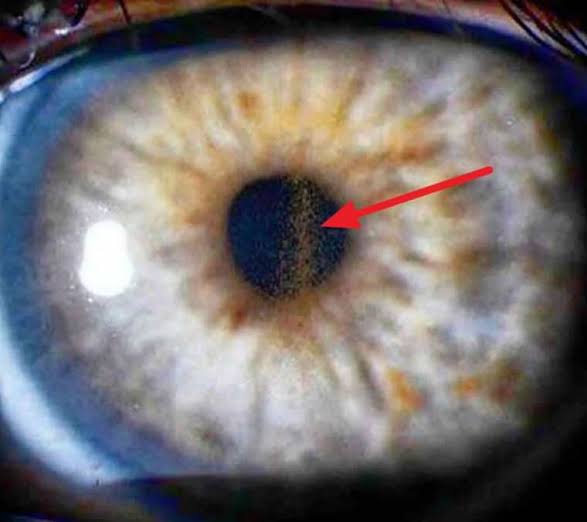 Pigment Dispersion Syndrome: A Mechanical Story