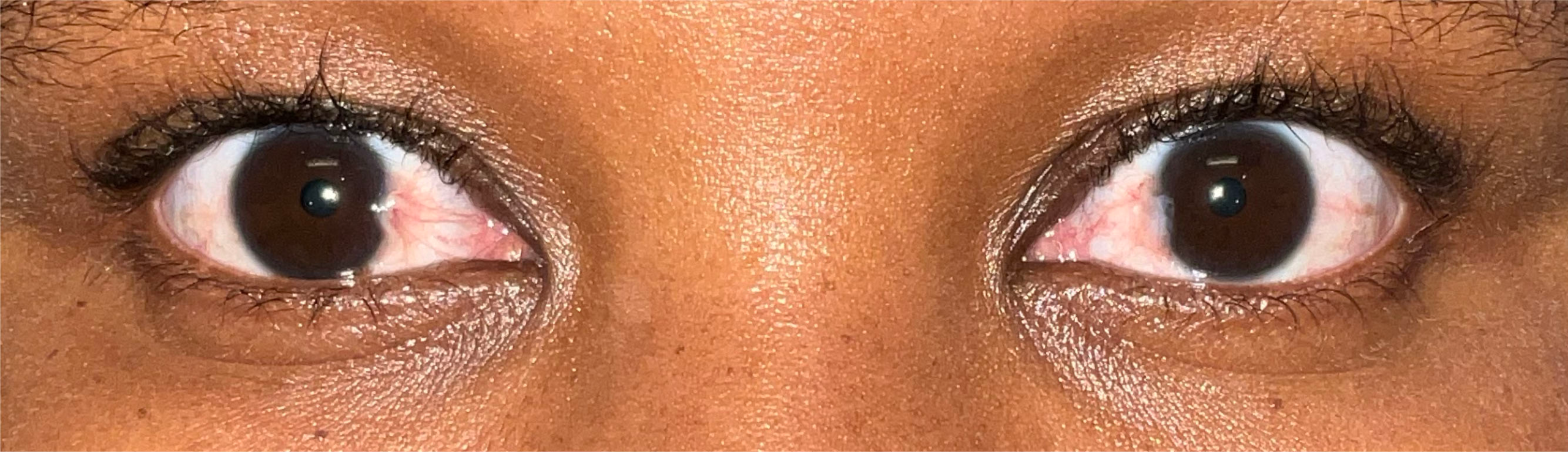 Pterygium Treatment