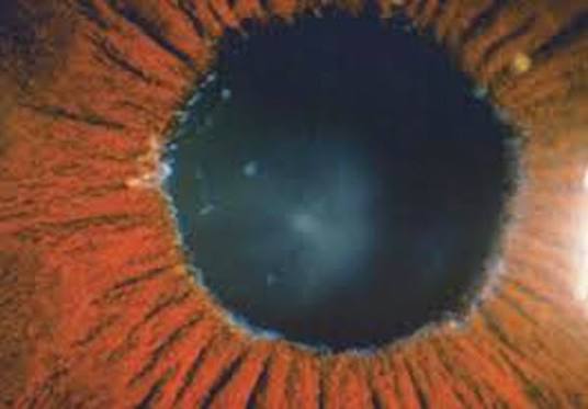 Pseudoexfoliation Syndrome and Glaucoma