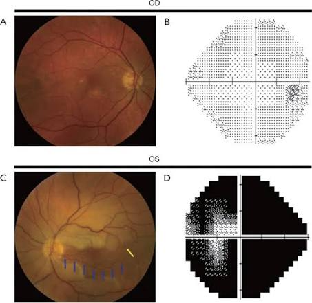 Retinal Artery Occlusion: A Stroke of the Eye