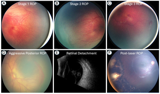 Retinopathy of Prematurity: ICROP3 Update