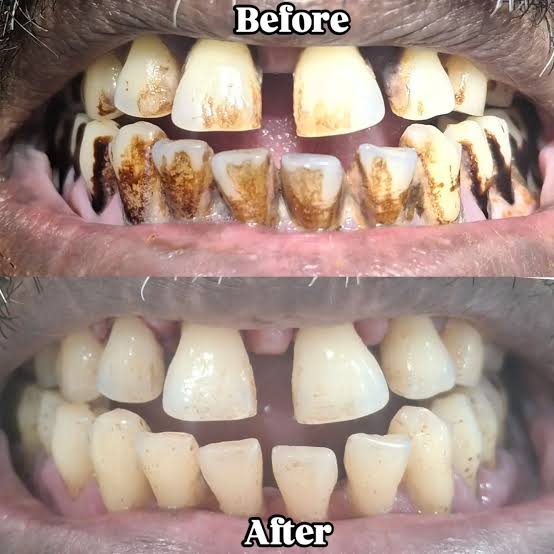 Teeth Scaling & Polishing