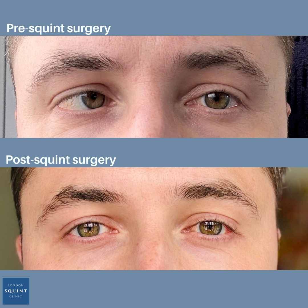 Squint (Strabismus) Treatment