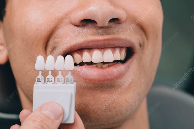 Teeth Whitening